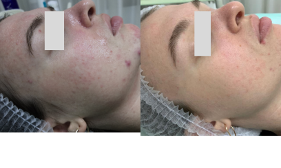 Пилинг Джесснера